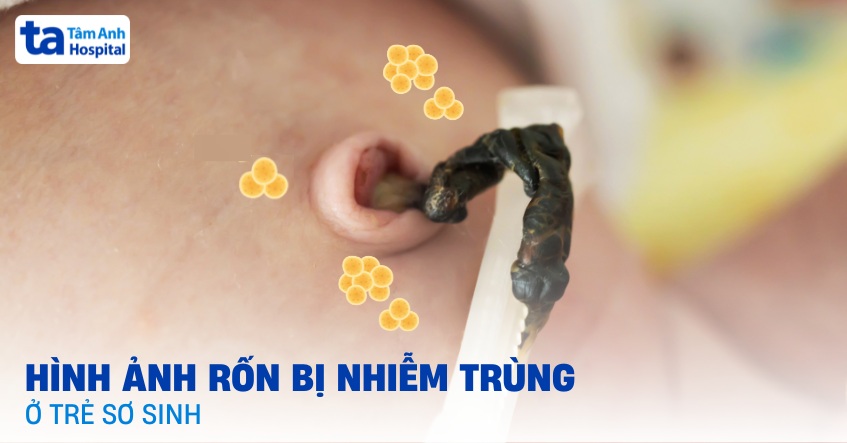 Hình ảnh rốn bị nhiễm trùng ở trẻ sơ sinh nên nhận biết sớm
