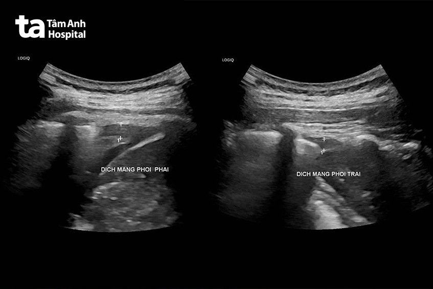 hình ảnh siêu âm màng phổi của chị hạnh