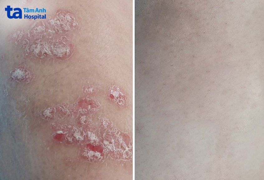 hình ảnh vảy nến trước và sau điều trị