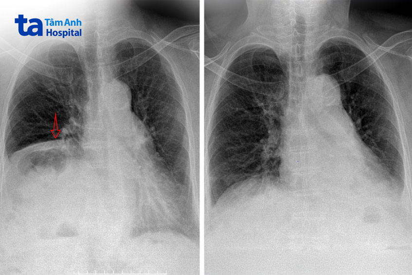 Hình ảnh X-quang trước mổ (bên trái) cho thấy cơ hoành phải lên rất cao trong lồng ngực, và hai ngày sau mổ (bên phải) cơ hoành phải trở lại vị trí bình thường