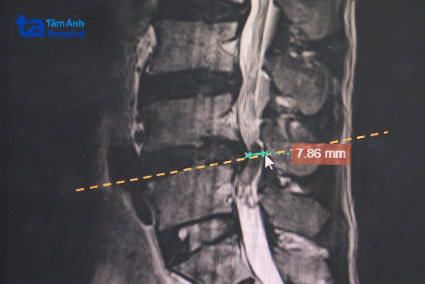 hình chụp mri thoát vị đĩa đệm của người bệnh