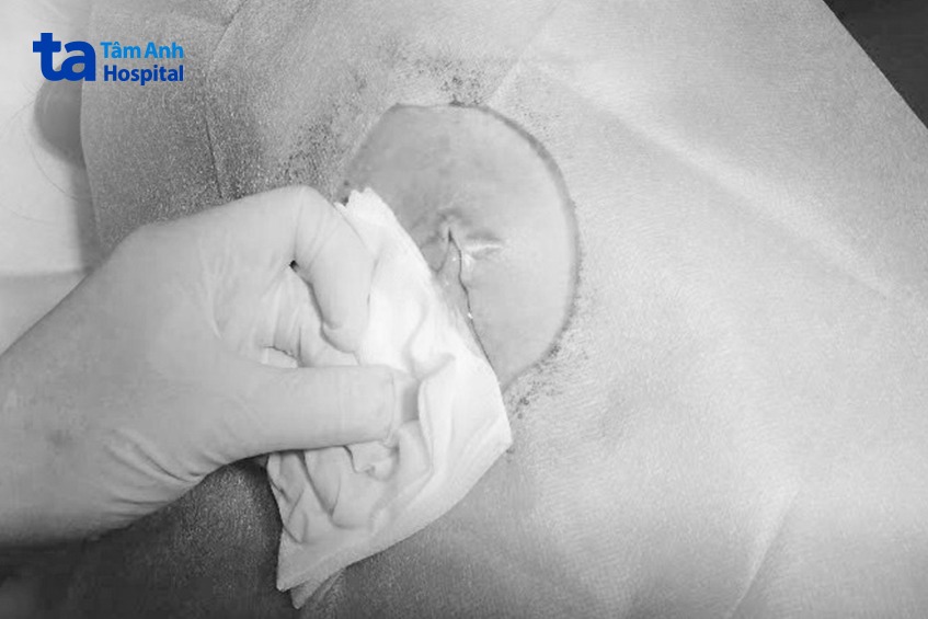 hình dịch mủ u bã đậu