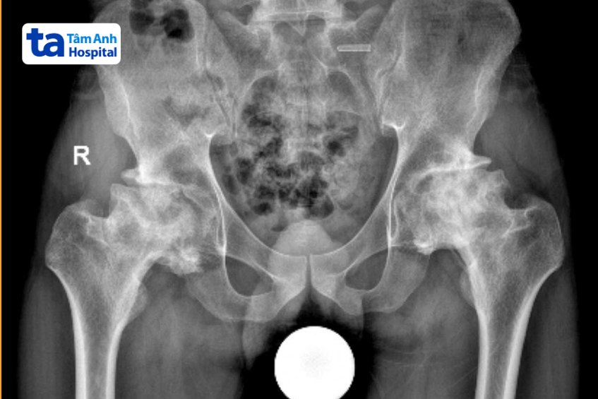 kết quả chụp mri cho bệnh nhân