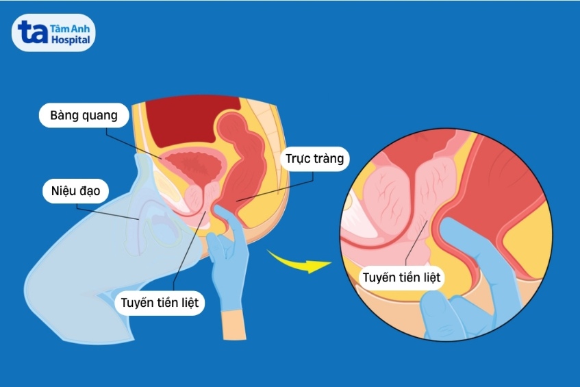 khám tuyến tiền liệt qua đường hậu môn trực tràng