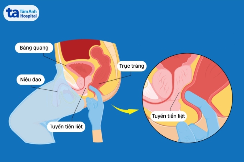 khám tuyến tiền liệt qua trực tràng