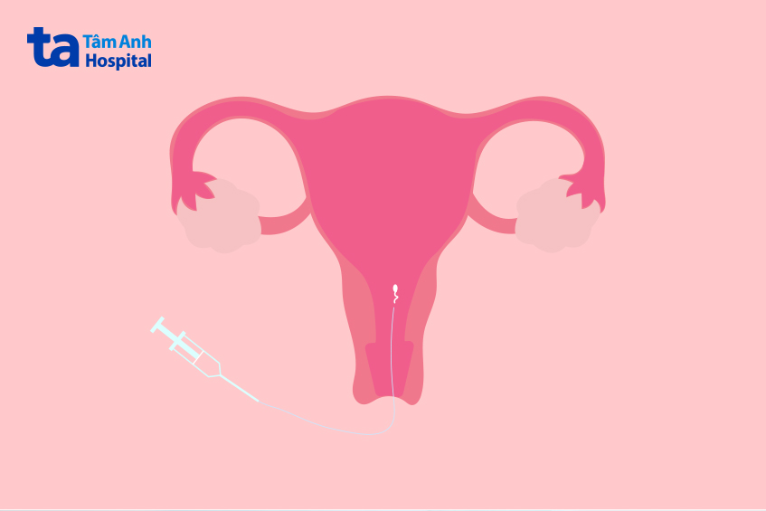 Khi trứng đã trưởng thành và đạt kích thước, bác sĩ sẽ tiến hành bơm IUI