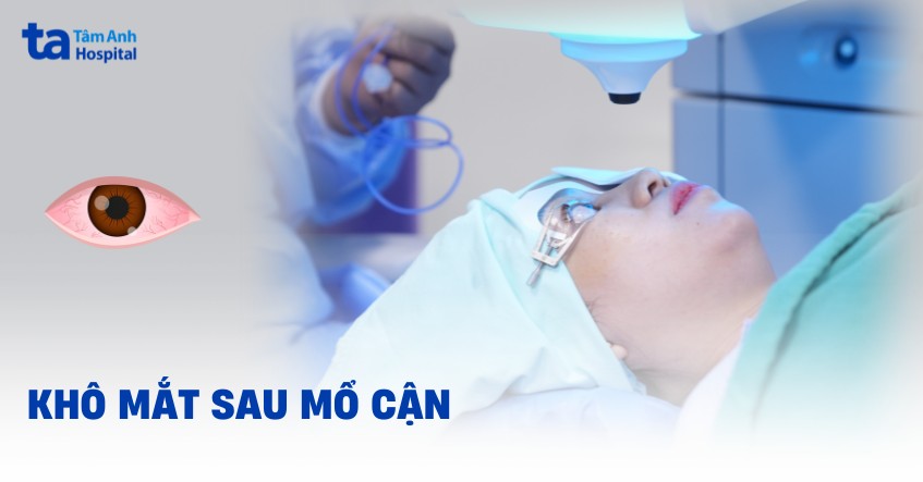 Khô mắt sau mổ cận Lasik là do nguyên nhân gì? Hướng dẫn xử lý