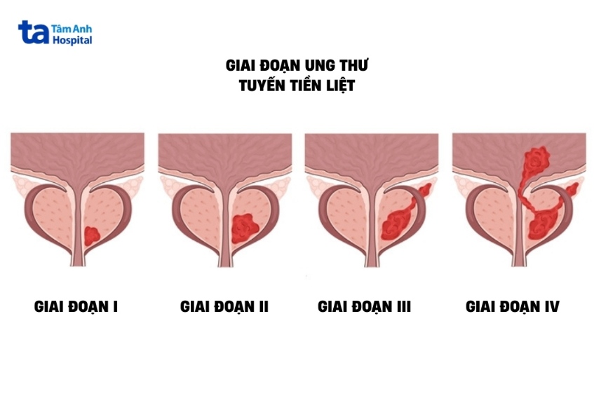 khối u qua giai đoạn ung thư tuyến tiền liệt