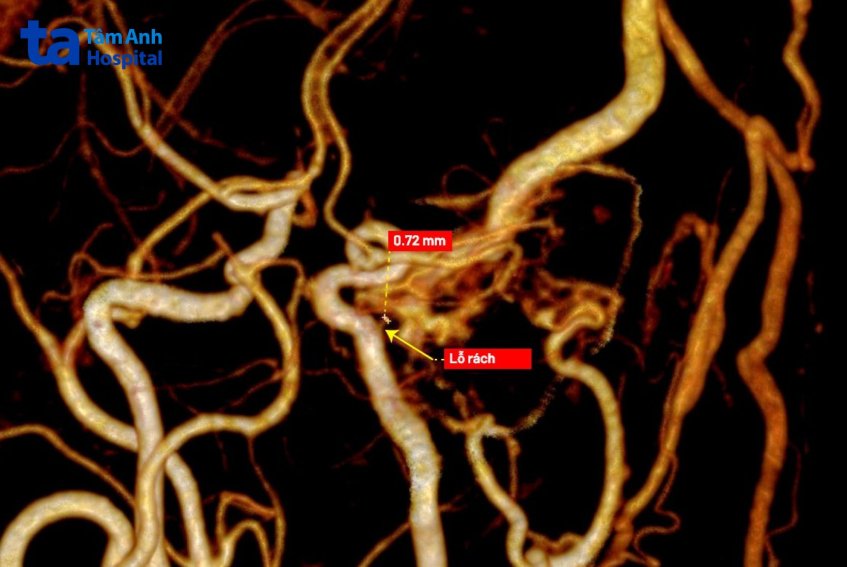 lỗ rách động mạch