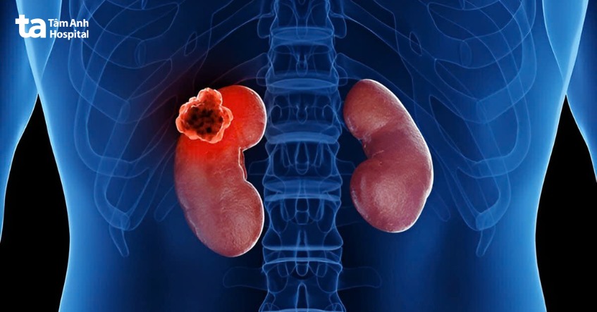 loại bỏ khối u chính xác nhờ robot da vin ci xi