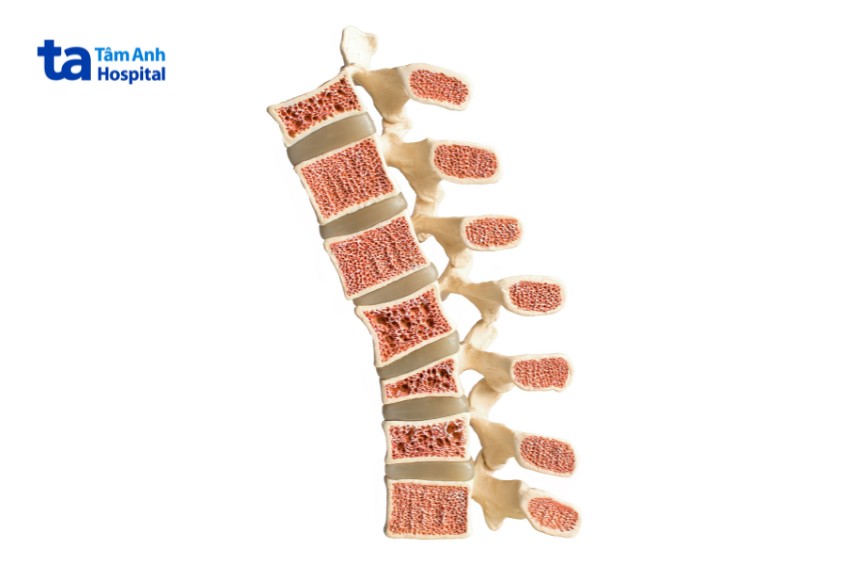 loãng xương gây đau nhức khó chịu