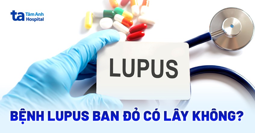 Giải đáp: Bệnh lupus ban đỏ có lây không?