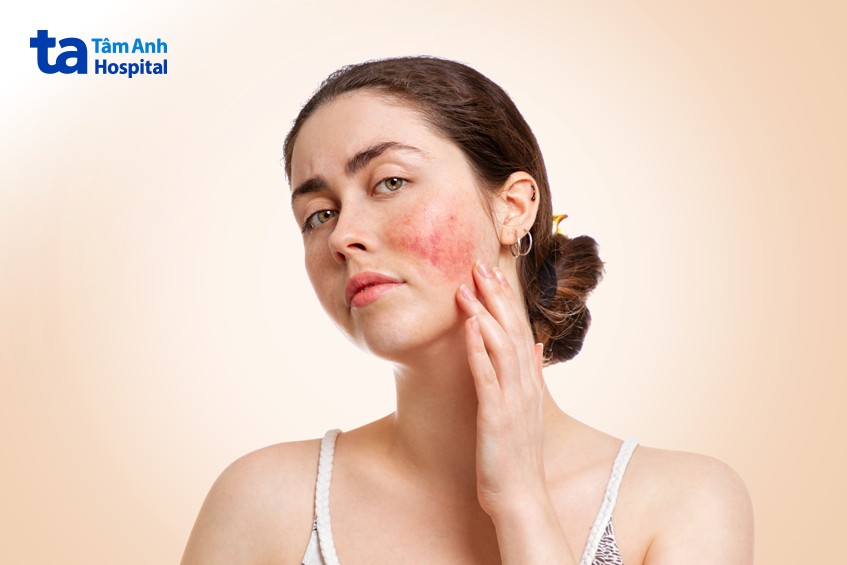 lupus ban đỏ phát ban ở má