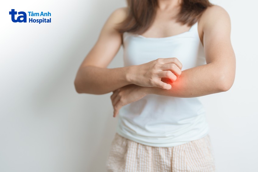 lupus tránh gãi mạnh vùng da