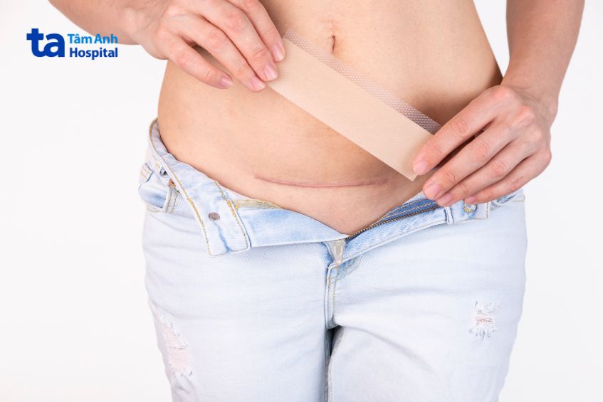 Mẹ có thể tham khảo ý kiến bác sĩ để được tư vấn miếng dán hoặc kem ngừa sẹo thích hợp để đảm bảo tính thẩm mỹ khi vết mổ đẻ lành