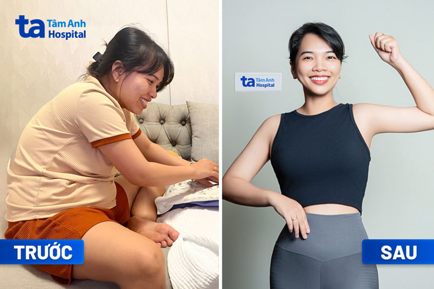 Chị Ngô Trần Thanh Thảo trước và sau giảm cân tại BVĐK Tâm Anh