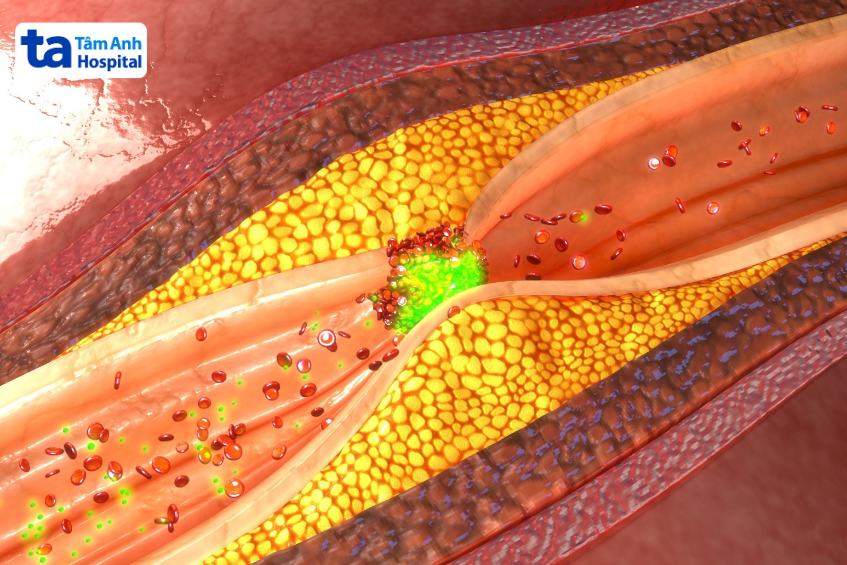 minh họa thuốc làm tan huyết khối