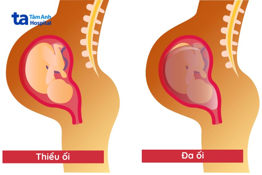 minh họa tình trạng đa ối trong thai kỳ