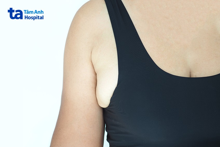 mỡ nách không ảnh hưởng sức khỏe
