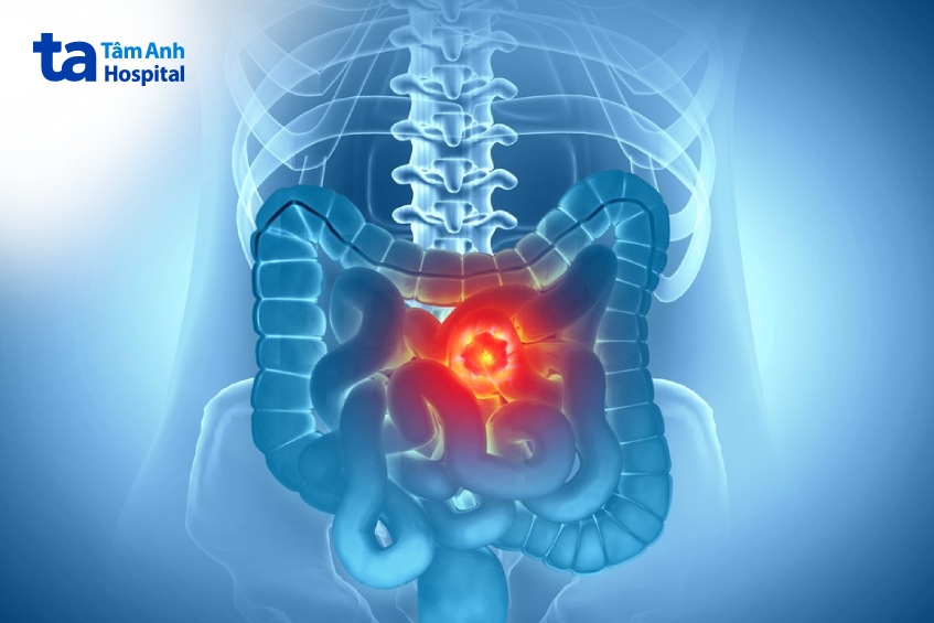 mô phỏng khối u ung thư đại tràng