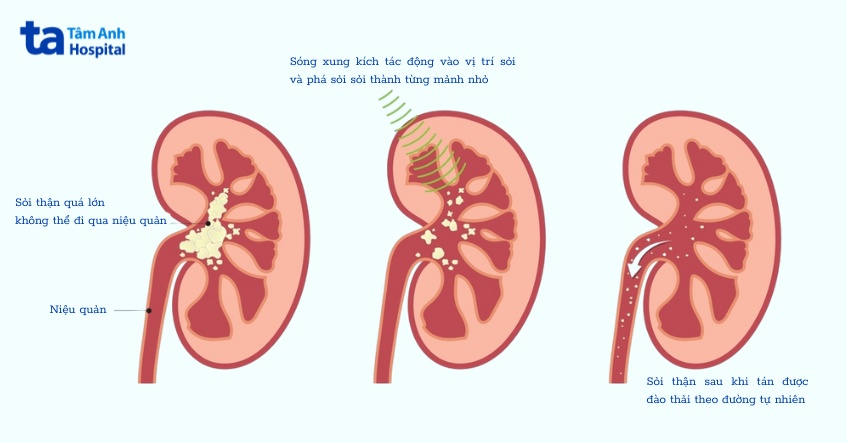 mô phỏng kỹ thuật tán sỏi ngoài cơ thể