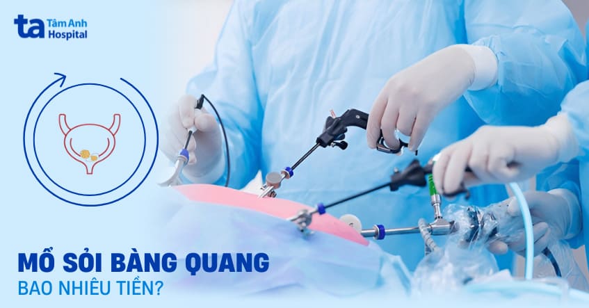 Mổ sỏi bàng quang bao nhiêu tiền? Chi phí có mắc không?