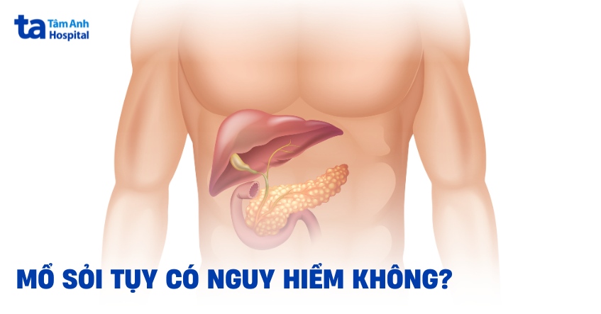Mổ sỏi tụy có nguy hiểm không? Biến chứng có thể gặp