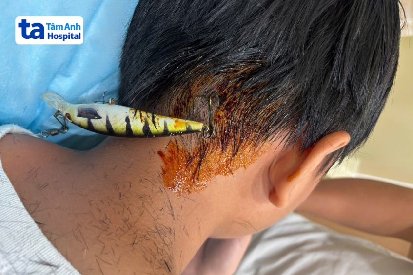 móc câu cá đâm vào gáy bé trung