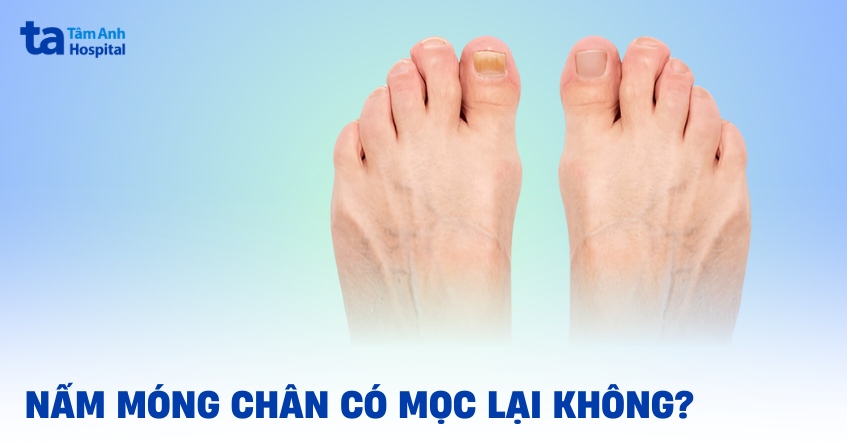 Móng chân bị nấm có mọc lại không? Yếu tố nào ảnh hưởng?