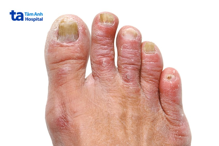 nấm móng chân có gây ảnh hưởng đến sức khỏe tổng thể không