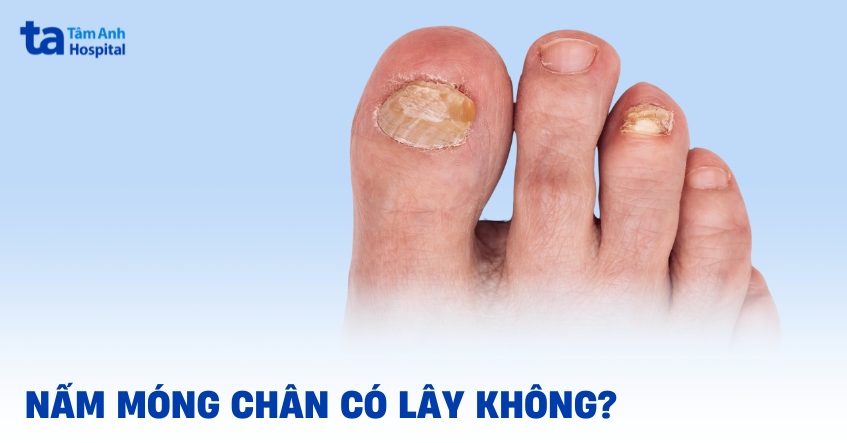 Nấm móng chân có lây không? Lây qua đường nào phổ biến?
