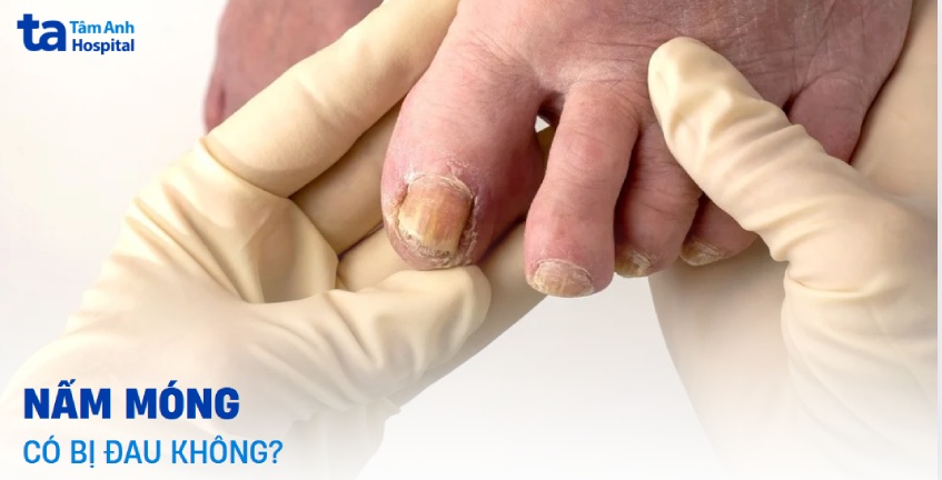 Nhiễm nấm móng có bị đau không? Hướng dẫn cách giảm đau hiệu quả
