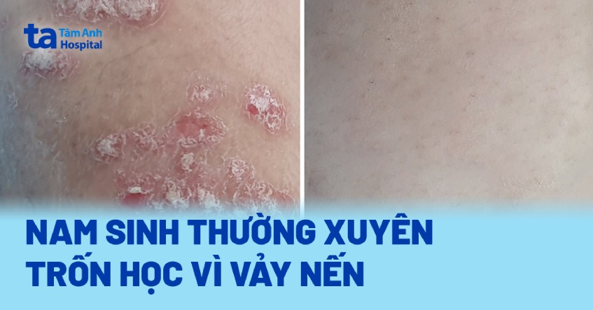 Nam sinh thường trốn học vì vảy nến