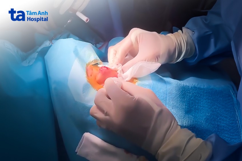 nặn mụn bị viêm mũi