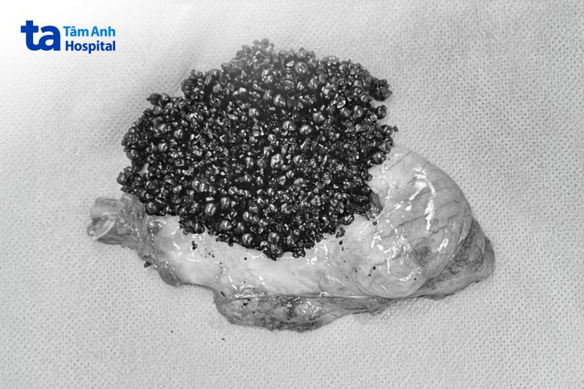 nghìn viên sỏi mật