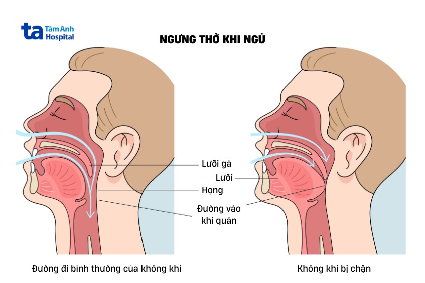 ngừng thở khi ngủ do chèn ép hô hấp
