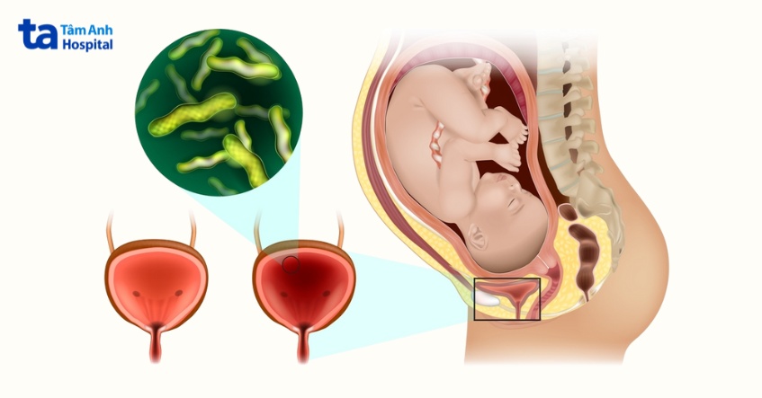 nguyên nhân do sự chèn ép của thai nhi