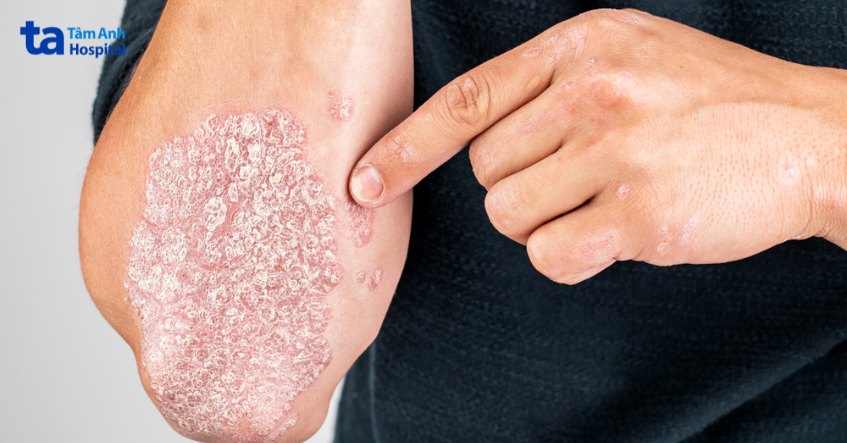 nguyên nhân xuất hiện vảy nến thể mảng