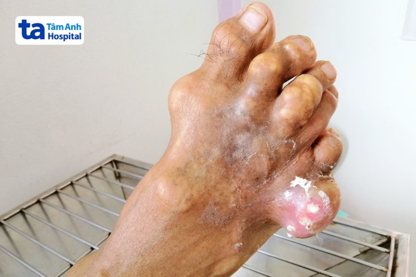 nhiễm khuẩn hạt tophi dễ bị ở nam giới