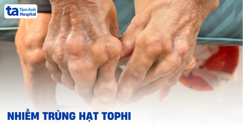 Nhiễm trùng hạt tophi có nguy hiểm không? Làm sao để phòng ngừa?