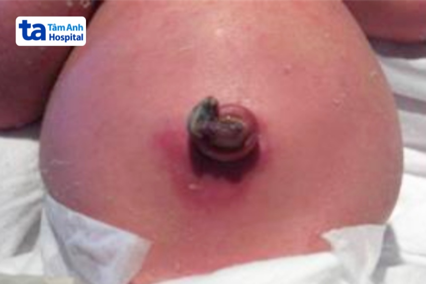 nhiễm trùng rốn khu trú