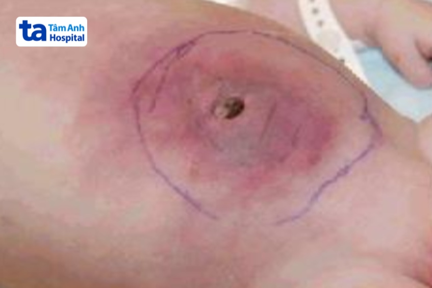 nhiễm trùng rốn ở trẻ sơ sinh mức độ nặng