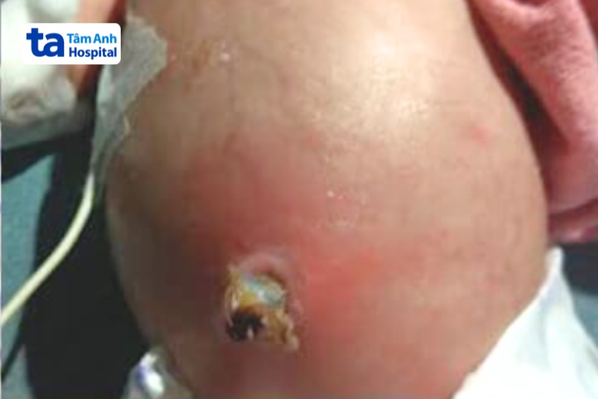 nhiễm trùng rốn sơ sinh mức độ nặng, gây sưng tấy