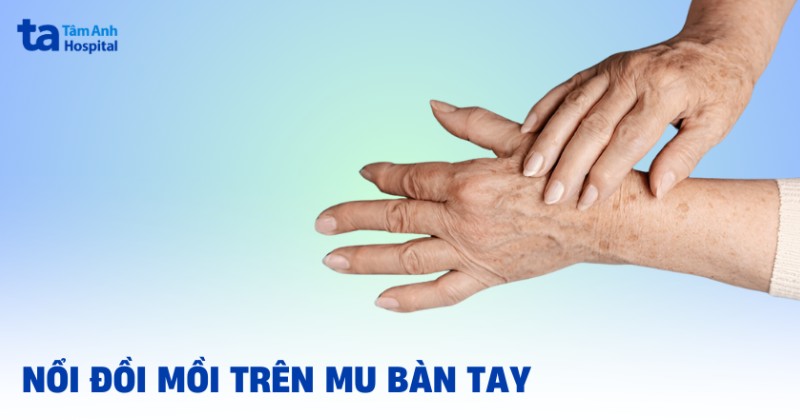 Nổi đồi mồi trên mu bàn tay: Nguyên nhân, cách nhận biết và điều trị