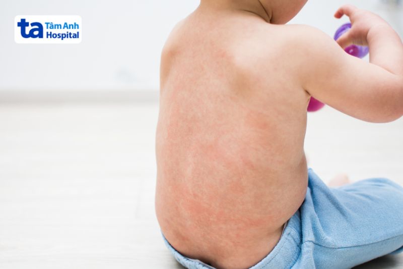 sốt phát ban và sốt xuất huyết có triệu chứng gần như nhau