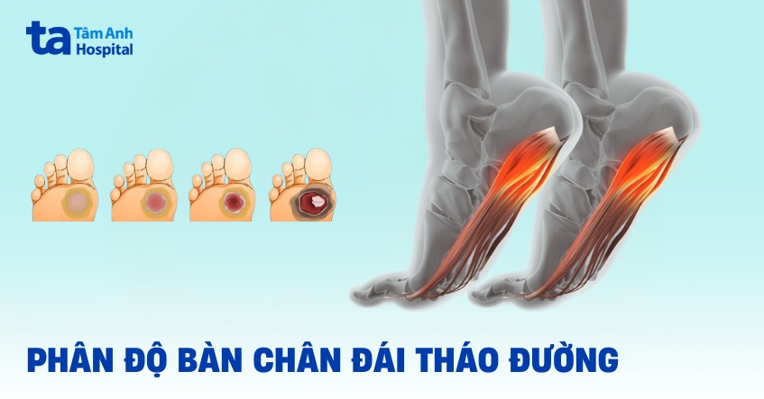 Phân độ bàn chân đái tháo đường theo Wagner Meggitt và theo thang điểm Pedis