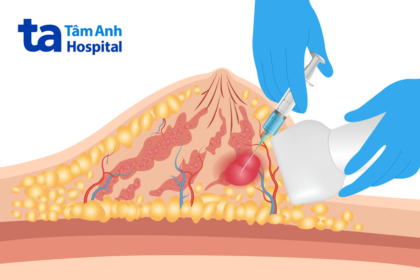 phân tích sai mẫu sinh thiết
