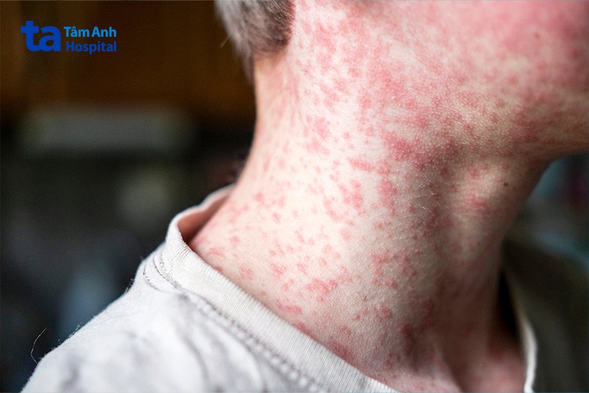 phát ban là dấu hiệu bệnh sởi người lớn