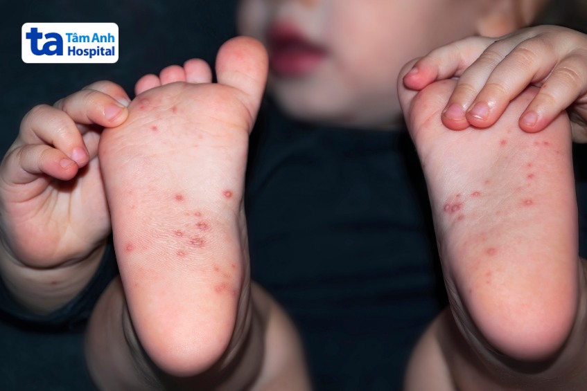 phát ban sởi có thể khiến trẻ bị ngứa ở giai đoạn toàn phát