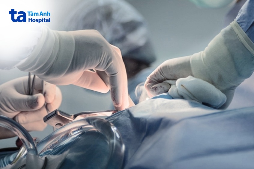 phẫu thuật điều trị ung thư đại tràng giai đoạn sớm